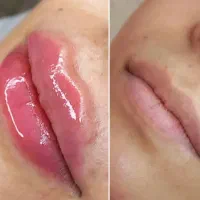 جشنواره ی تزریق بوتاکس و ژل و جوانسازها (هایفو،RF)|خدمات آرایشگری و زیبایی|تهران, نیلوفر|دیوار