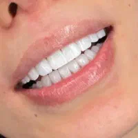 اجرای ویژه کامپوزیت بدون تراش