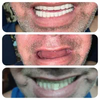 انجام درمان تخصصی دندان مصنوعی در م ن ز ل