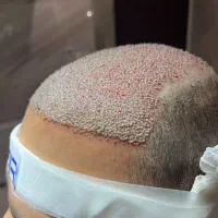 کاشت مو و ریش در شهر اردبیل