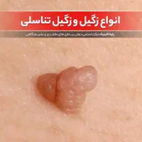 رفع کامل زگیل کاملا گیاهی بدون لیزر یا فریز