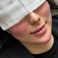 استخدام اپراتور لیزر در کلینیک زیبایی