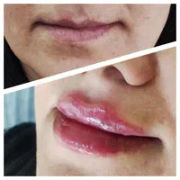 تخفیف تابستانه ژل و بوتاکس