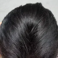 پروتز مو  کارکرده