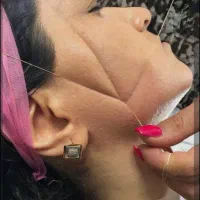 تخفیف اپلاسیون و اصلاح