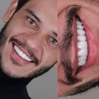 کامپوزیت دندان روکش سرامیکی لمینت دندانپزشکی