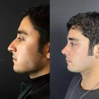 عمل و جراحی بینی 23تا25 میلیون /مشاوره رایگان|خدمات آرایشگری و زیبایی|کرج, عظیمیه|دیوار