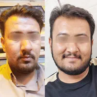 چاقی صورت طبیعی(تضمینی)