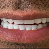 دندان مصنوعی تخصص ماست ( اقساط )|خدمات آرایشگری و زیبایی|اصفهان, لاله|دیوار