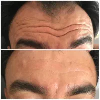 جشنواره ژل وبوتاکس مصپورت ۵۵۰