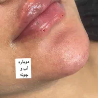 ژل و بوتاکس ‌‌پاکسازی|خدمات آرایشگری و زیبایی|مشهد, شهید معقول|دیوار