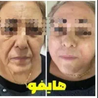 جشنوارلیفت/جوانسازی/هایفو/فقط1جلسه باهدیه رایگان