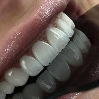 مدل کامپوزیت لیرینگ|خدمات آرایشگری و زیبایی|تهران, اباذر|دیوار