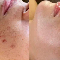 فیشال تخصصی پوست و لیفت لمینت ابرو