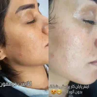 درماپلینیگ درما پاکسازی|خدمات آرایشگری و زیبایی|زابل, |دیوار