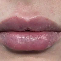 ژل لب ، بوتاکس ، فیلر توسط پزشک