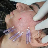 لیفت و برطرف کردن افتادگی صورت(دکتر علی بابایی)