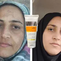 سفیدشو درمان کک و مک و لک