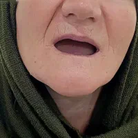 دندان لمینیت مصنوعی بانو ۲۰ میلیون|خدمات زیبایی و سلامت|تهران, کاج|دیوار