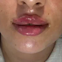 فیلر بادی،بوتاکس،ژل ۵۵۰ کاشت نخ چربی سوزامبدینگ