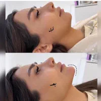 بوتاکس لیبل دار واحدی ۲۰۰ ژل اورجینال توسط پزشک|خدمات آرایشگری و زیبایی|اصفهان, احمدآباد|دیوار