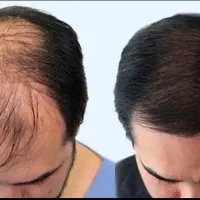 کاشت مو و ابرو|خدمات آرایشگری و زیبایی|بوشهر, |دیوار