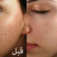 از بین بردن جای جوش و لک ،به روش مزونیدلینگ|خدمات آرایشگری و زیبایی|شیراز, معالی‌آباد|دیوار