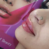 تزریق ژل و بوتاکس و هایفوتراپی پروفایلو فیلر بادی|خدمات آرایشگری و زیبایی|شیراز, فرهنگ شهر|دیوار
