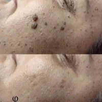 کلاس اموزشی حذف زایده های پوستی،اسکین تگ،خال،زگیل