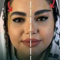 تزریق فیلر بوتاکس نخ لیفت بلفاروپلاستی توسط پزشک|خدمات آرایشگری و زیبایی|تبریز, |دیوار