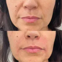 فیلر خط خنده و گونه تخفیف ویژه