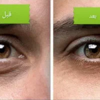 جراحی زیبائی پلک بالا|خدمات آرایشگری و زیبایی|گلپایگان, |دیوار