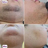 لیزر موهای زائدتیتانیوم‌۲۰۲۵و پلینگ با تضمین کیفیت|خدمات آرایشگری و زیبایی|شیراز, معالی‌آباد|دیوار