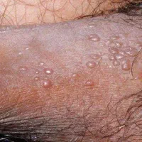 بهبود زگیل تناسلی|آرایشی، بهداشتی، درمانی|کیش, |دیوار