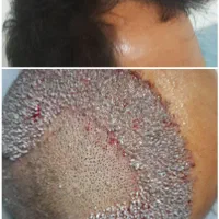 کاشت تخصصی مو در شیراز|خدمات آرایشگری و زیبایی|بوشهر, |دیوار