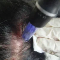 بوتاکس و خال برداری توسط پزشک در نعمت آباد