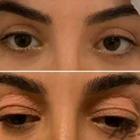 عمل زیبائی پلک و عمل رفع پف زیر چشم