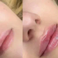 نیازمند مدل ژل و بوتاکس