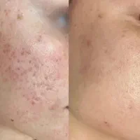 رفع اسکار های عمیق در پنج جلسه