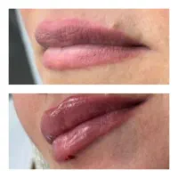 آموزش تزریق ژل لب.ژل گونه بوتاکس انواع مزوتراپی|خدمات آموزشی|آبادان, |دیوار