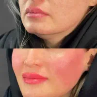 پی آر پی (prp) بایوفیلر اگزوزوم ژل فیلربادی بوتاکس|خدمات آرایشگری و زیبایی|کرج, گوهردشت|دیوار