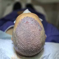 کاشت مو ابرو و ریش prp مزوتراپی