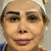 تخفیف کاشت ابرو پر تراکم و طبیعی