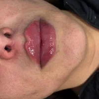 تزریق ژل و بوتاکس