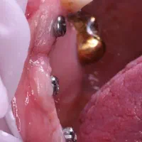 دندانپزشکی ایمپلنت دیجیتال ارتودنسی کامپوزیت لمینت|خدمات آرایشگری و زیبایی|شبستر, |دیوار