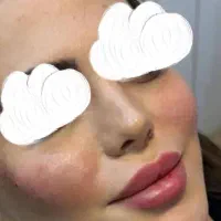 تزریق ژل و بوتاکس
