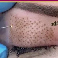 دستگاه پلکسر بدون بخیه|آرایشی، بهداشتی، درمانی|محمودآباد, |دیوار