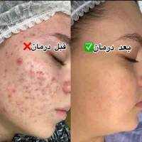 فروش پک ضدلک و ضدجوش