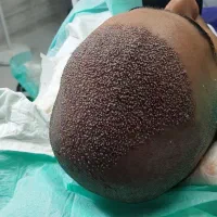 تخفیف ویژه کاشت مو و ابرو|خدمات آرایشگری و زیبایی|کرمانشاه, |دیوار