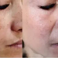 پاک کردن تتو و لک و روشن سازی|خدمات آرایشگری و زیبایی|تهران, قیطریه|دیوار